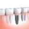 ניתוח השתלת שיניים